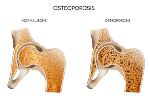 In-Home Care Town of Tioga - Managing Osteoporosis with In-Home Care Support
